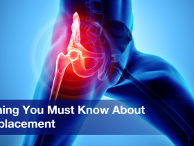 Everything You Must Know About Hip Replacement